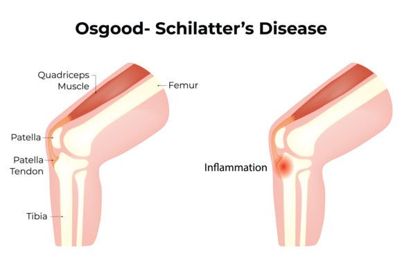 Download Osgood Schilatters Disease Science - Disease Collection